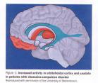 Stein, D.J. (2002). Obsessive -Compulsive Disorder. The Lancet, 360 (9330), 397-405.