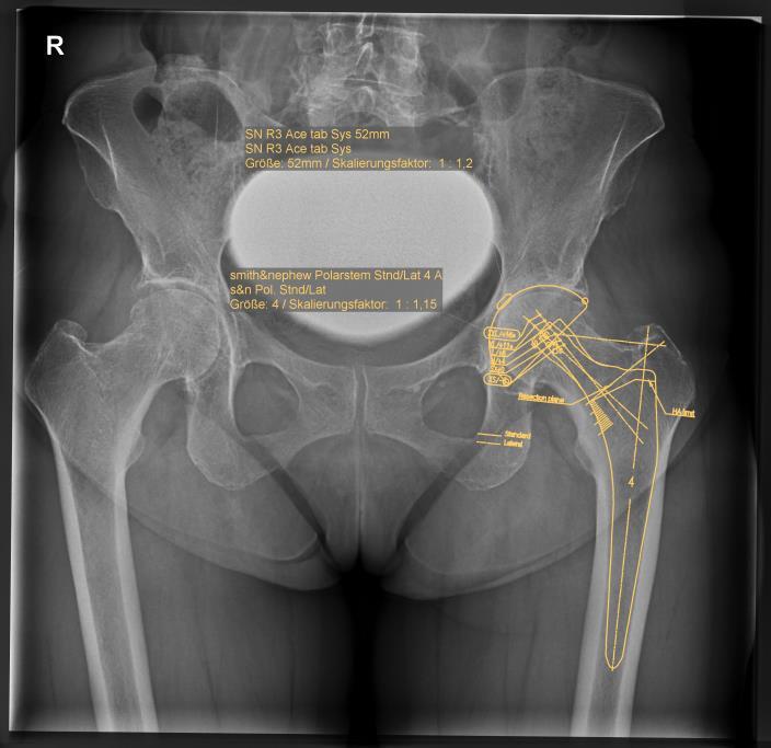Röntgenbilder einer fortgeschrittenen Arthrose der linken Hüfte (=Coxarthrose) linke Hüftgelenk axial geröntgt Beckenübersichtsaufnahme Zur Vorbereitung und Planung des operativen Eingriffs gehört