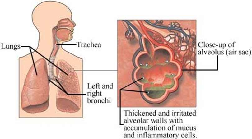 Definition Akut verlaufende, meist infektiöse Entzündung im Lungenparenchym
