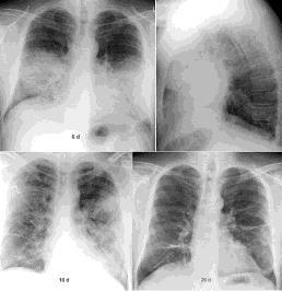 Infektionen Lokale und systemische (opportunistische) Infektionen mit ubiquitären Schimmelpilzarten bei Immungeschwächten: - Krebs, Chemotherapie, Organtransplantation, HIV mit ubiquitärem