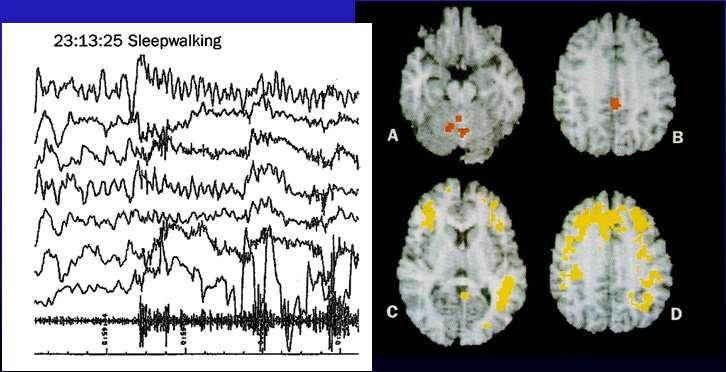 compared to awake DD: epileptische Anälle frontal > temporal 5 sec High