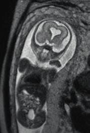 Die fetale MRT kann die sonographische Diagnose ergänzen, korrigieren oder bestätigen und dient oft als Ausgangsuntersuchung für postnatale Kontrollen. Ausgewählte Literatur: Garel, C.