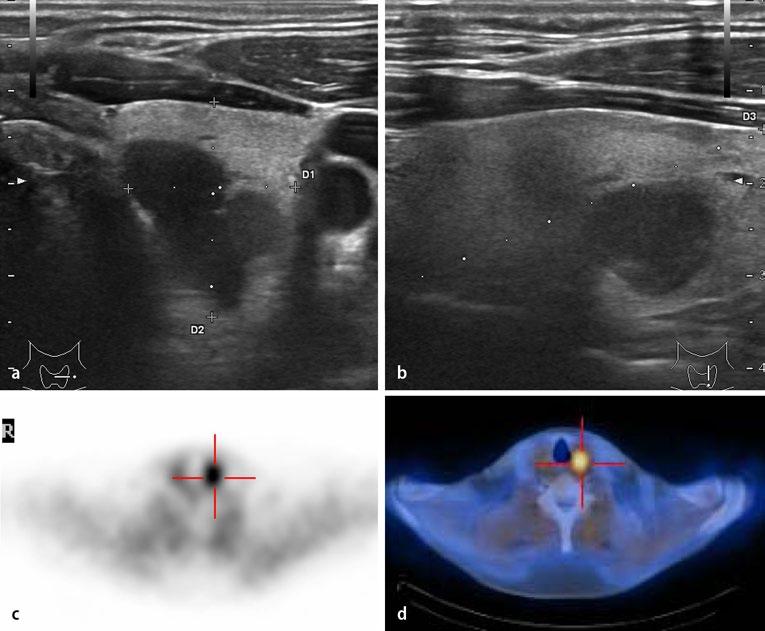 Abb. 3 8 Ultraschallbild eines Schilddrüsenknotens links (a), der szintigraphisch im SPECT/CT (b) als intrathyreoidales Nebenschilddrüsenadenom gewertet werden muss F extrem hohen Parathormonwerten