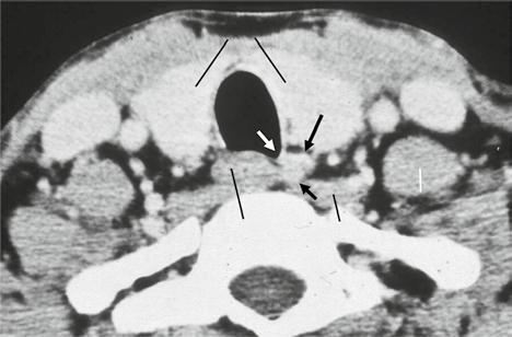 1 8 a Skizze eines Transversalschnitts der Halsregion auf Höhe der Schilddrüse: Typischerweise sind vergrößerte Epithelkörperchen dorsomedial der Schilddrüsenlappen gelegen (nach [1]).
