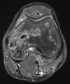 enchondroma up to 3% of knee MRI TA: lobulated, chondroid matrix, peripheral enhancement bone marrow infarct TA: serpentiginous