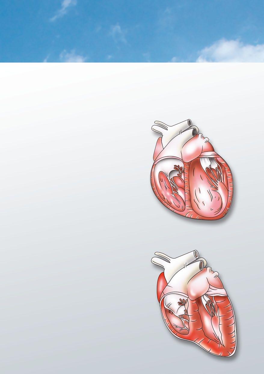 Verwirbelung an den Herzklappen, wenn diese nicht mehr ordnungsgemäß schließen. Was ist eine DCM (dilatative Kardiomyopathie)?