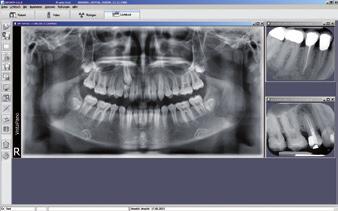 Imaging-Software DBSWIN zur Diagnoseunterstützung Die ergonomische, netzwerkfähige Imaging-Software DBSWIN optimiert alle Bilder automatisch, speichert sie ab und stellt diese an allen Arbeitsplätzen