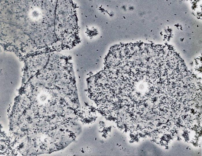 Petersen: Infektionen in Gynäkologie und Geburtshilfe) Abb. 3. Clue-cell mit Methylenblau angefärbt (aus Eiko E.