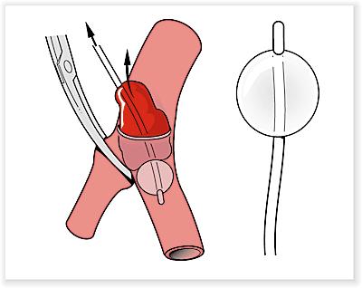 Anhang Intraoperative Zusatzmaßnahmen Unter intraoperativen Zusatzmaßnahmen wurden alle Verfahren zur Desobliteration eines arteriosklerotisch veränderten Gefäßes während der Operation verstanden.