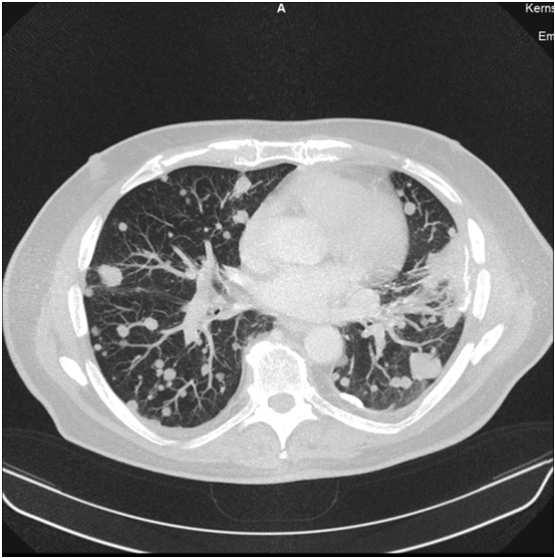Fall 2: Lungentumor Diagnostik: Schritt 2 CT: Bestätigung multipler Läsionen in beiden Lungenflügeln incl.