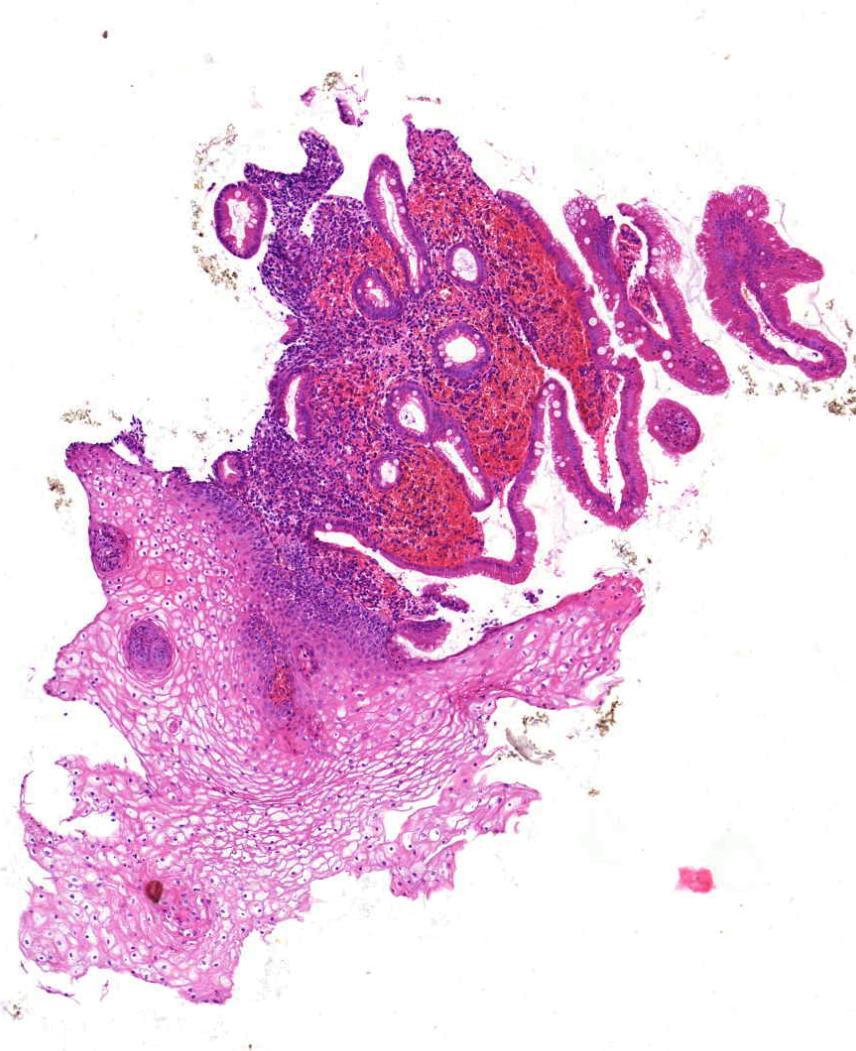 Ösophagus Barrettösophagus Intestinale Metaplasie: Becherzellen statt