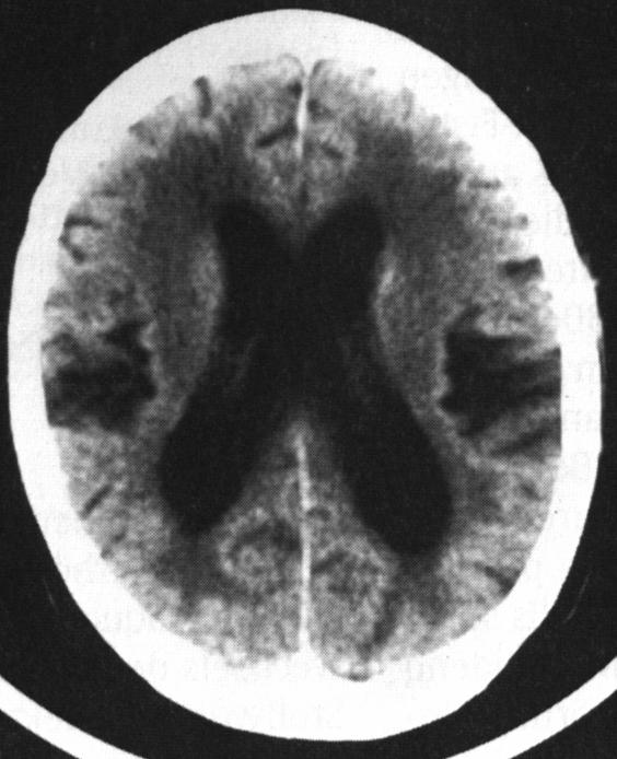 Encephalopathie mit multiplen lacunären Infarkten Rindeninfarkte Bei