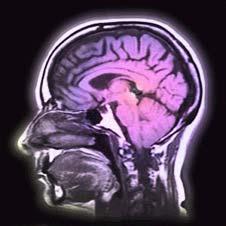 Parkinson Krankheit Morbus Parkinson entspricht einer degenerativen Stammganglienerkrankung; es kommt zum Untergang melaninhaltiger Zellen in der Substantia nigra (mindestens 60-80% der Zellen müssen
