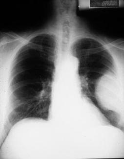 Verschiedene Krankheitsbilder Staublunge - Asbestose Krebserkrankungen -