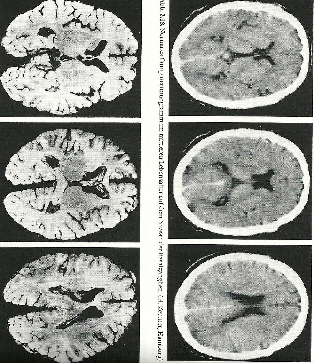 23 Cerebrale Bildgebung: Morbus Parkinson Morbus Parkinson: Altersentsprechend