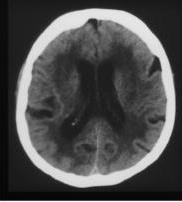 24 Vaskuläre Enzephalopathie: vaskuläres Parkinson Syndrom möglich Ischämisch bedingte Veränderung des