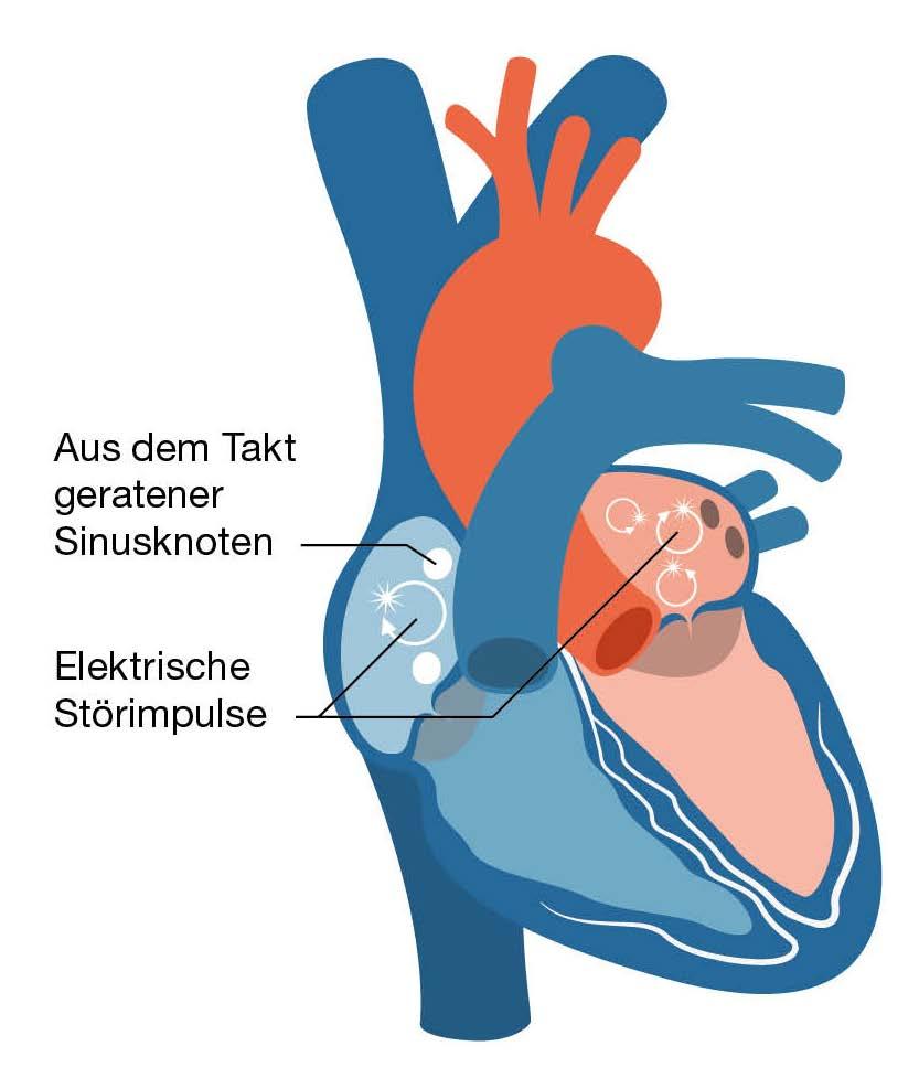 2. Vorhofflimmern häufig unbemerkt. Ein gesundes Herz Ein Herz mit Vorhofflimmern Was passiert beim Vorhofflimmern?