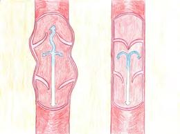 DIE VENENKLAPPEN UND DIE MUSKELPUMPE Beim Ulcus cruris venosum sind die Venen (blau) der Beine betroffen. In den Venen wird sauerstoffarmes, verbrauchtes Blut zum Herzen zurücktransportiert.