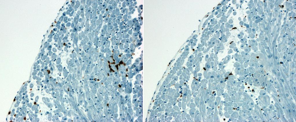 Borderline Myokarditis CD3 CD68 14 T-Lymphozyten (inklusive 4 Makrophagen) pro mm 2