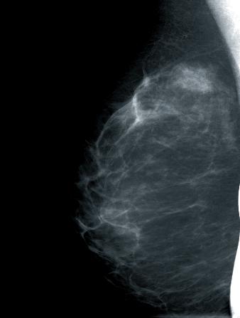 Diagnostisch relevante Drüsenkörperanteile nicht abgebildet Eine unvollständige Abbildung der Brust wird abgestuft entweder als geringer Mangel ( Brust einschließlich Cutis, Subcutis und Fettgewebe