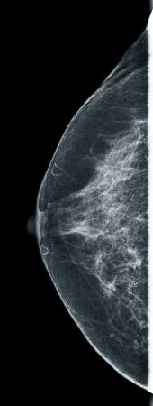 Artefakte mit Einschränkung der diagnostischen Aussage Es sind nicht zur Brust gehörende Störstrukturen dargestellt.