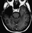 rung [16]. Ähnliche Resultate fanden sich in anderen Studien, bei denen verschiedene Techniken der Amygdala- Hippokampektomie untersucht wurden.