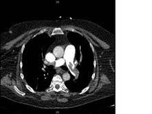 Abbildung 1. Zentrale Lungenembolie beidseits Abbildung 2.