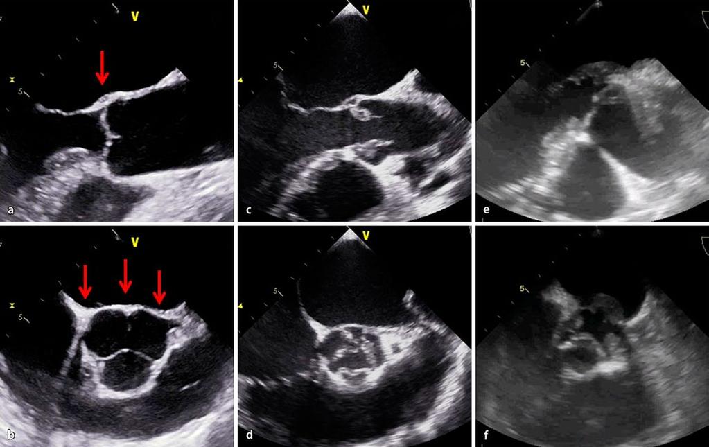 Abb. 14 8 Unauffällige Aortenklappe und fibröse aorticomitrale Übergangszone (Pfeile) im parasternalen transösophagealen a Längs- und b Kurzachsenschnitt sowie c, d auffällige Befunde in