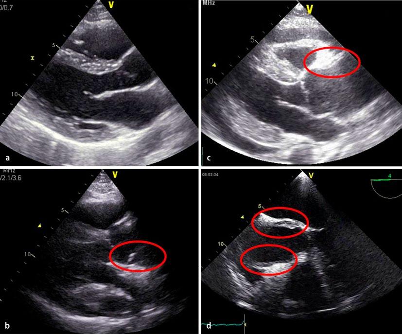 Abb. 15 9 Unauffällige Aortenwurzel und proximale Aorta ascendens a im parasternalen Längsschnitt sowie b im gleichen Anschnitt bei Vorliegen einer Stanford-A-Dissektion im dorsalen Wurzelbereich bzw.