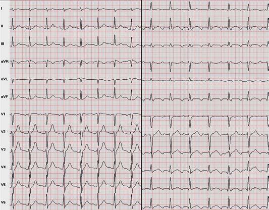 604 Übersicht Abb. 2 12-Kanal-EKG (25 mm / s) zur Beurteilung einer regelmäßigen anhaltenden supraventrikulären Tachykardie (Kammerfrequenz ca.