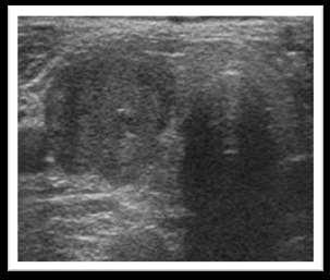 Sonographie Beste Untersuchung zum Nachweis von Knoten