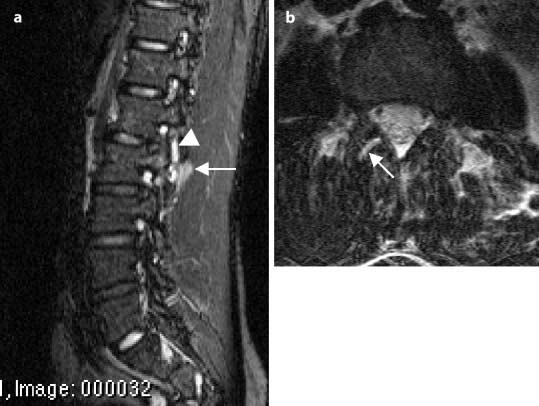 Abb. 15a,b Motorradunfall. Typ-B-Verletzung. a Sagittal T2-gewichtetes Bild mit Fettunterdrückung durch die lumbale Wirbelsäule.