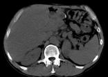 HCC nativ arteriell portal-venös KM-Injektions