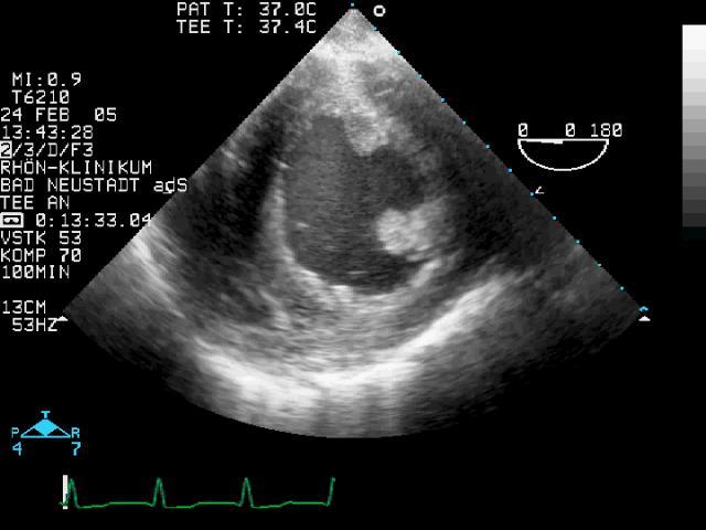 Der koronarkranke Patient Monitoring Zusätzlich zum Basismonitoring Ischämieerkennung im 5-Kanal-EKG, arterielle