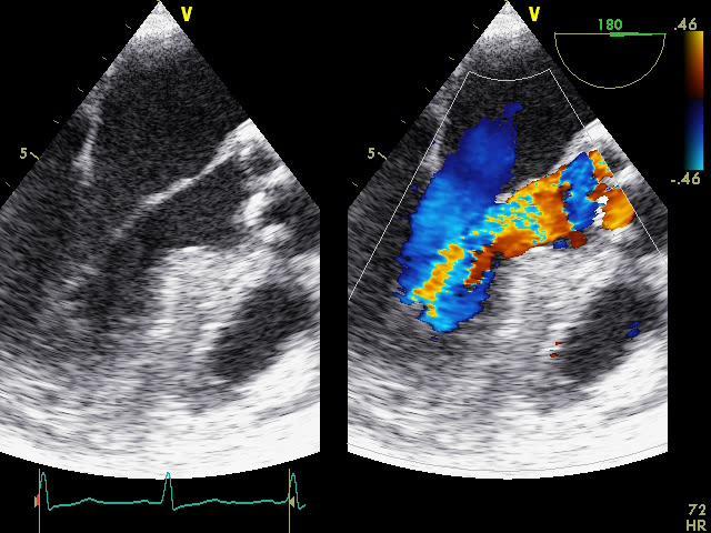 Aorteninsuffizienz Monitoring Zusätzlich zum Basismonitoring arterielle Druckmessung und ZVK Echokardiografie ist ein wichtiges Instrument, um bei schwerer AI