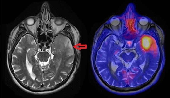 MRT-PET Links: MRT-Bild, Rechts: Überlagerung MRT mit PET(hier Hirntumor) Quelle: