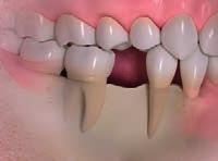 IMPLANTATE HELFEN, IHRE GESICHTSFORM ZU ERHALTEN Warum Kieferknochen Zähne brauchen, um in Form zu bleiben In einem gesunden Mund überträgt die Zahnwurzel Kaukräfte auf den Kiefer.