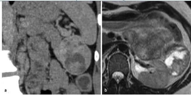 Solide pseudopapilläre Neoplasie CT MRT 24 % Brambs HJ, Juchems M: Zystische Tumoren des Pankreas.