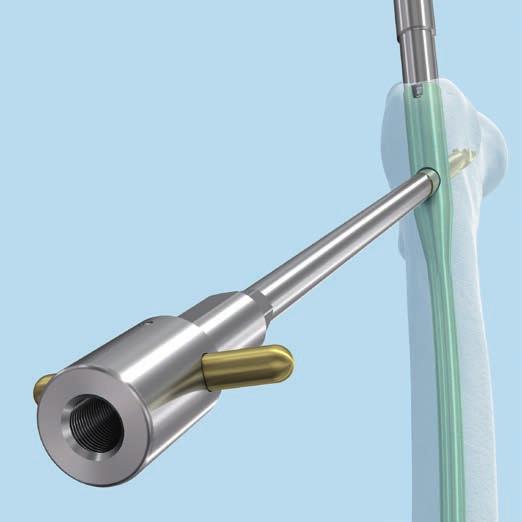 TFN Implantatentfernung Option B Schraube und Verriegelungsbolzen entfernen Instrumente 357.377 Verbindungsschraube für Helix-Klinge für TFN 357.