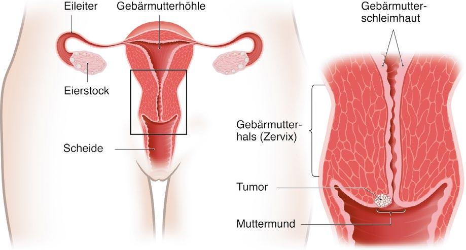 Was ist Gebärmutterhalskrebs? Gebärmutterhalskrebs ist der Name für bösartige Tumoren, die am unteren Teil der Gebärmutter entstehen.