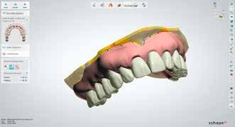 Digital Denture Design-Check Jetzt kontrolliert das System das Prothesendesign auf mögliche Fehler. Werden Gingivalinien verletzt, können diese während der Zahnfleischgestaltung korrigiert werden.