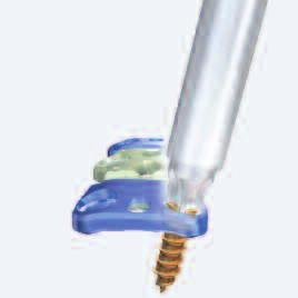2 Schraube entfernen Benötigtes Instrument 352.311 Schraubenzieher für Extraktion Zum Entfernen der Schraube muss der Schraubenzieher für Extraktion verwendet werden.