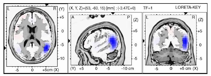 Abbildung 13: Dreidimensionale Lokalisierung der zerebralen Region, die für den experimentellen Effekt der N400 verantwortlich ist (mittels LORETA): Die Verarbeitung von Metaphern ruft Aktivierungen
