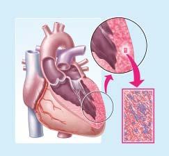 in der Brust, wie sie auch bei einem Herzinfarkt auftreten können, sollte umgehend der Hausarzt oder Kardiologe aufgesucht werden, um die Herzbeteiligung in einem frühen Stadium zu erkennen und zu