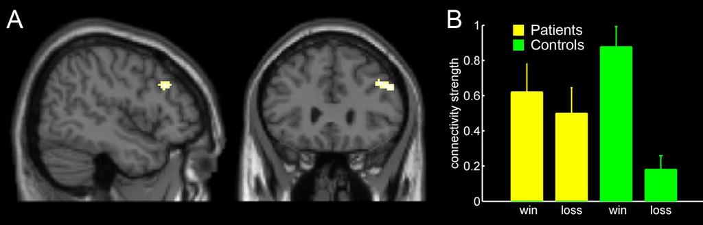 Reduzierte Lernleistung korreliert mit gestörter Vernetzung ventrales Striatum frontaler Kortex