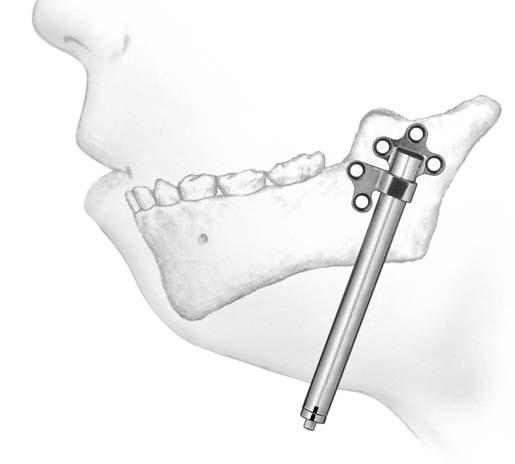 Für eine der Anatomie entsprechende Schraubenplatzierung darf der Distraktor bis zu 5mm geöffnet werden.