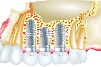 Zahnlücke: Implantat oder Zahnbrücke?
