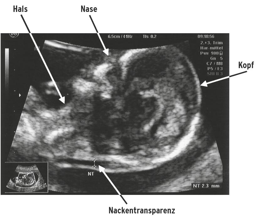 Durch die Fortschritte in der Ultraschall-Technik hat man Anfang der 1990er Jahre entdeckt, dass alle Kinder in der 12. bis 14. Schwangerschaftswoche also schon am Ende des 3.