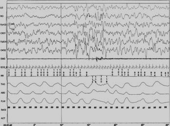 Ergebnisse Abbildung 6: Kortikales Arousal im Ruhigen Schlaf (QS), spontan (aufgezeichnet bei einem 38-Wochen-alten Knaben; ebenso Veränderungen im EEG, der Herzfrequenz und des Atmungsmusters)