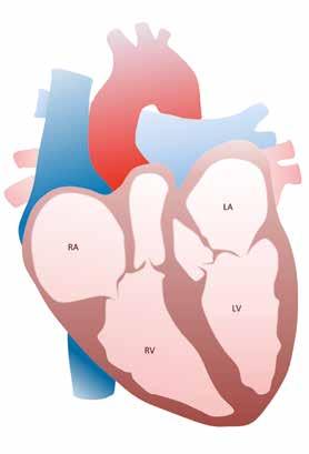 Gesundes Herz Herz bei Amyloidose Die kardiale Amyloidose Amyloidose bezeichnet eine Gruppe von seltenen Erkrankungen, bei denen es zur Ablagerung von Eiweiß in unterschiedlichen Organen kommt.